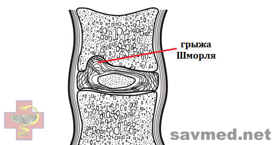 СавМед Савченко Грыжа шморля Лечение