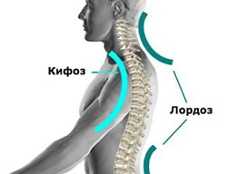 СавМед Савченко лордоз
