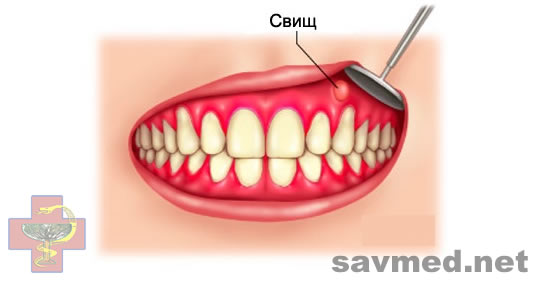СавМед Савченко Периостит Симптомы